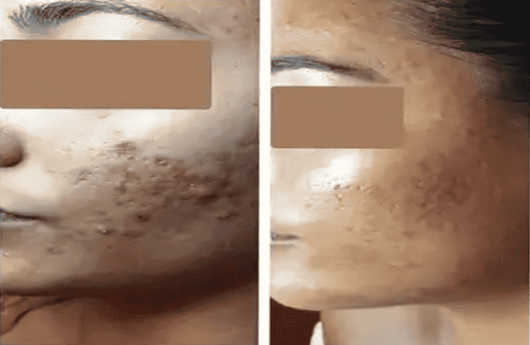 Before and after of Michele Corley client using home care products recommended for oily/combination acne with underlying congestion and pih.