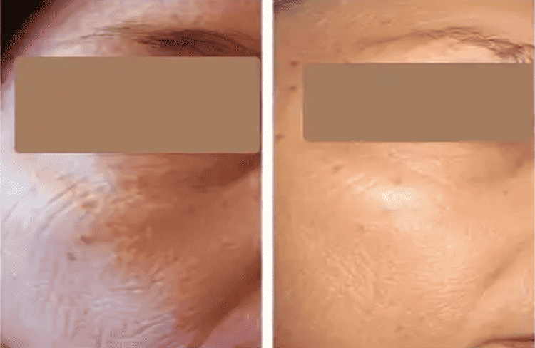 Before and after of Michele Corley client using home care products recommended for extremely dry, dehydrated, environmentally damaged skin.