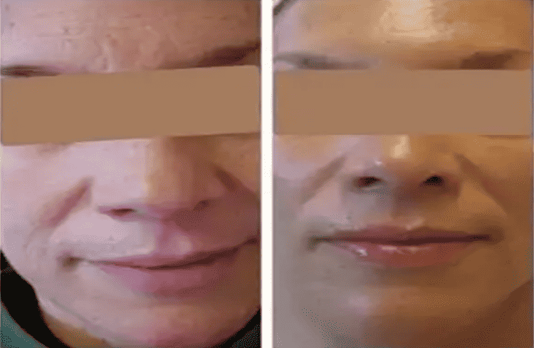 Before and after of Michele Corley client using home care products recommended for extremely dry, dehydrated skin.