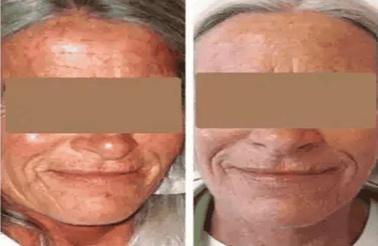 Before and after of Michele Corley client using home care products recommended for dry, sensitive, environmentally damaged skin.