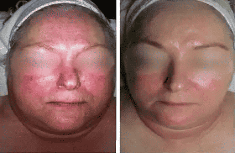 Before and after of Michele Corley client using home care products recommended for environmental damage, rosacea, sensitive and capillary activity.